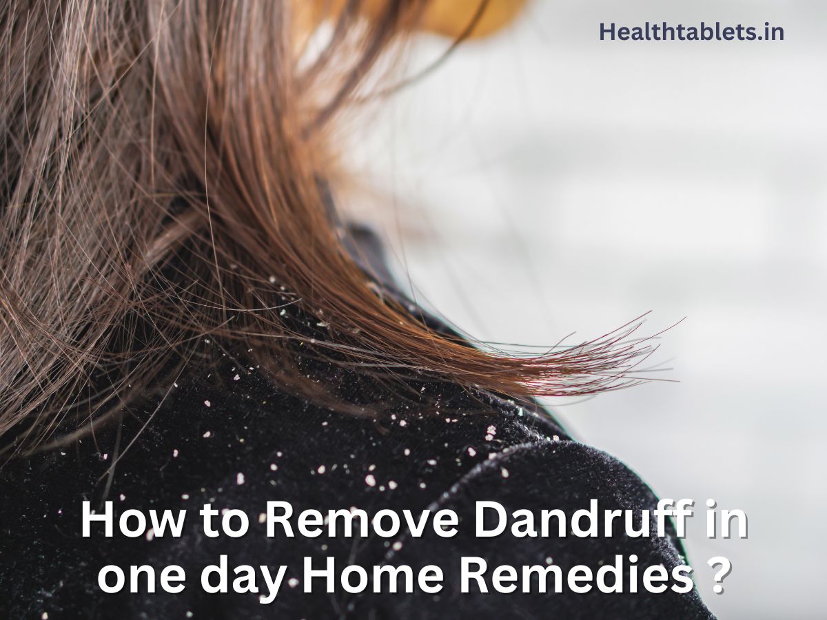 How to Remove Dandruff in one day Home Remedies